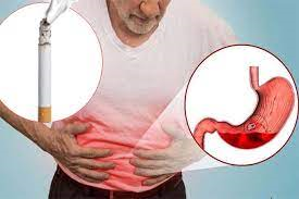 Cai thuốc lá làm giảm trào ngược dạ dày