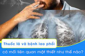 Hút thuốc lá làm tăng nguy cơ mắc bệnh lao