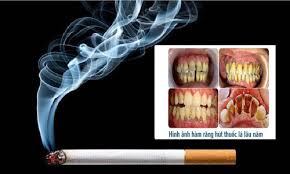 Tác hại của thuốc lá đến răng miệng